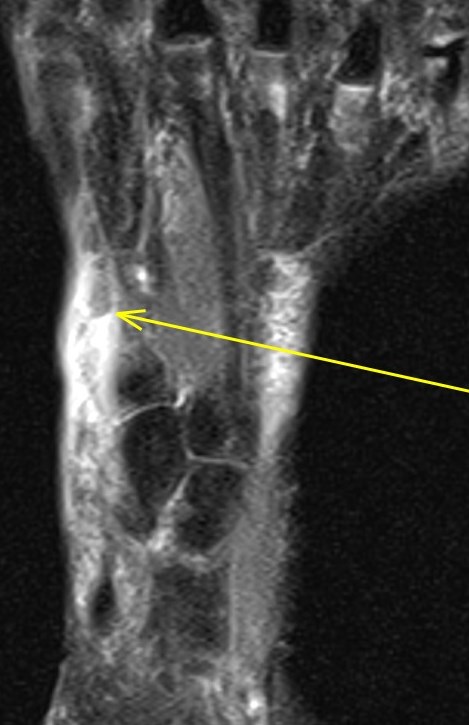 Figure 4 for case Extensor hallucis longus tendon ( RID3188 ) laceration